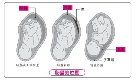 胎盤剝離方式|胎盤問題全解析